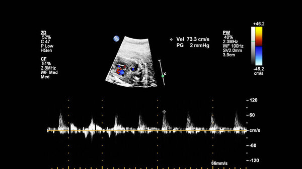 УЗИ с эхокардиографией плода

