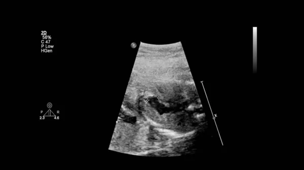 Ecrã Ultrassonográfico Com Ecocardiografia Fetal — Fotografia de Stock