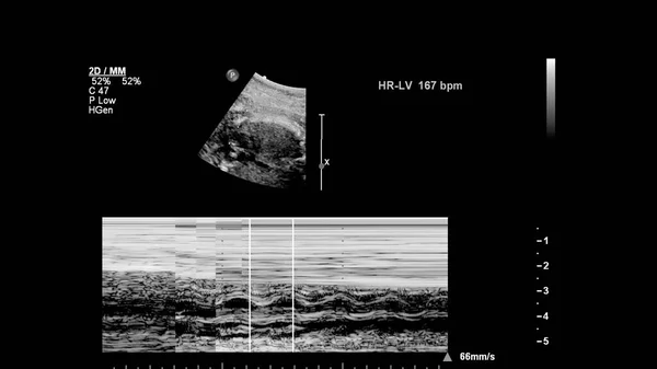 Ecrã Ultrassonográfico Com Ecocardiografia Fetal — Fotografia de Stock