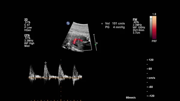 Ekran Usg Echokardiografią Płodu — Zdjęcie stockowe