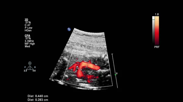 Ultrazvuková Obrazovka Fetální Echokardiografií — Stock fotografie