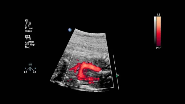 Ecrã Ultrassonográfico Com Ecocardiografia Fetal — Fotografia de Stock