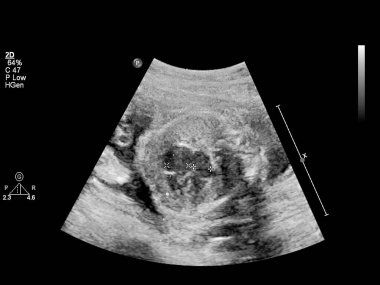 Fetal ekokardiyografi ile ultrasonografi ekranı