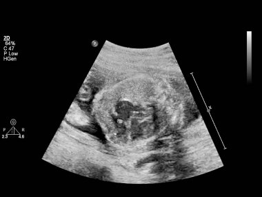 Fetal ekokardiyografi ile ultrasonografi ekranı