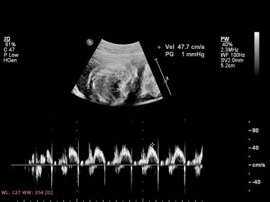 Fetal ekokardiyografi ile ultrasonografi ekranı
