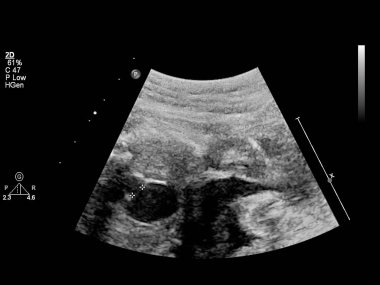 Fetal ekokardiyografi ile ultrasonografi ekranı