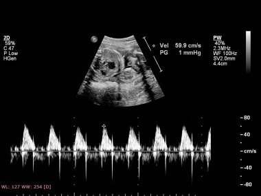 Fetal ekokardiyografi ile ultrasonografi ekranı