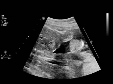 Fetal ekokardiyografi ile ultrasonografi ekranı