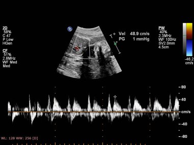 Fetal ekokardiyografi ile ultrasonografi ekranı