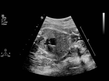 Fetal ekokardiyografi ile ultrasonografi ekranı