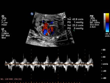 Fetal ekokardiyografi ile ultrasonografi ekranı