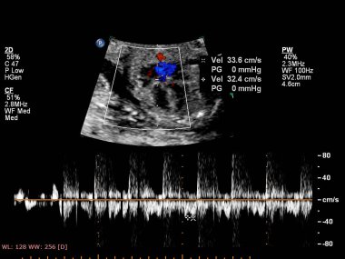 Fetal ekokardiyografi ile ultrasonografi ekranı