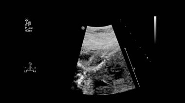 Fetal ekokardiyografi ile ultrasonografi ekranı