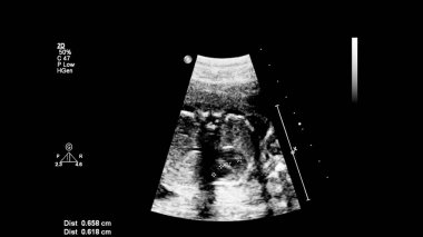 Fetal ekokardiyografi ile ultrasonografi ekranı
