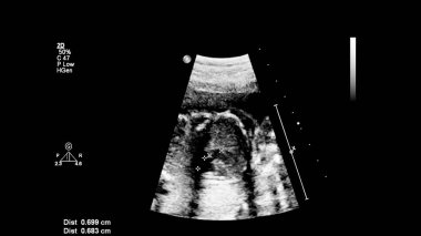 Fetal ekokardiyografi ile ultrasonografi ekranı