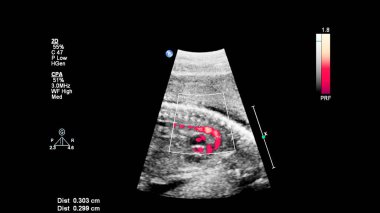 Fetal ekokardiyografi ile ultrasonografi ekranı