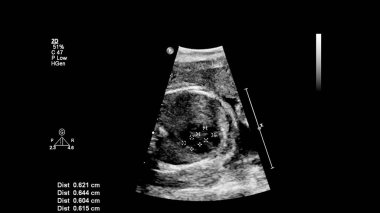 Fetal ekokardiyografi ile ultrasonografi ekranı