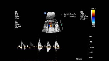 Fetal ekokardiyografi ile ultrasonografi ekranı