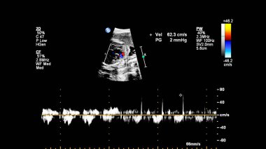 Fetal ekokardiyografi ile ultrasonografi ekranı