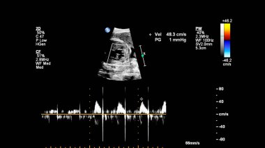 Fetal ekokardiyografi ile ultrasonografi ekranı