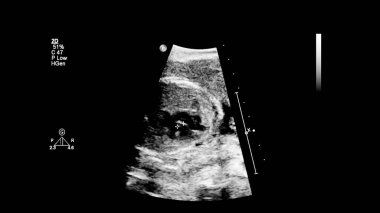 Fetal ekokardiyografi ile ultrasonografi ekranı