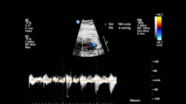 Fetal ekokardiyografi ile ultrasonografi ekranı