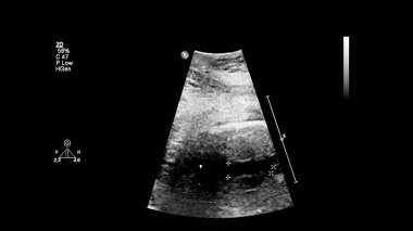 Fetal ekokardiyografi ile ultrasonografi ekranı