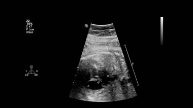 Fetal ekokardiyografi ile ultrasonografi ekranı