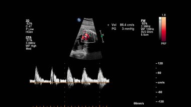 Fetal ekokardiyografi ile ultrasonografi ekranı