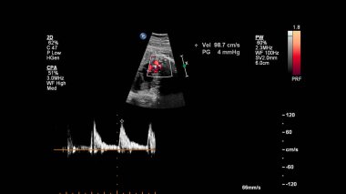 Fetal ekokardiyografi ile ultrasonografi ekranı