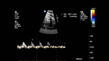 Fetal ekokardiyografi ile ultrasonografi ekranı