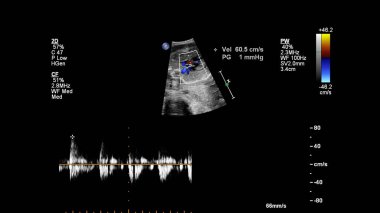 Fetal ekokardiyografi ile ultrasonografi ekranı