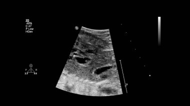 Fetal ekokardiyografi ile ultrasonografi ekranı