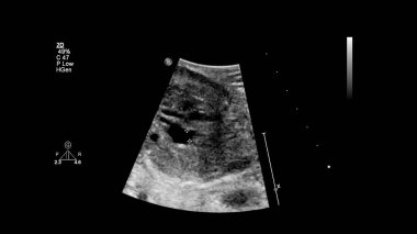 Fetal ekokardiyografi ile ultrasonografi ekranı