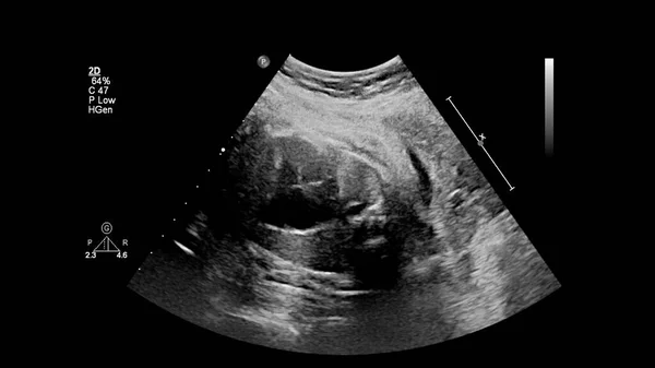 Ultraschalluntersuchung Des Fetalen Herzens Mit Hypoplastischem Linksherzsyndrom — Stockfoto
