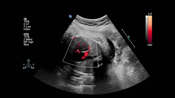 Ultrasound Examination Fetal Heart Hypoplastic Left Heart Syndrome — Stock Photo, Image