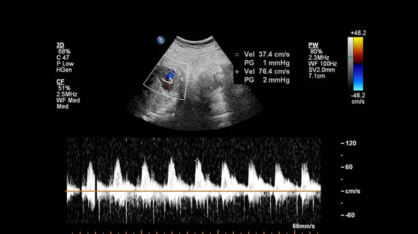 Exame Ultrassonográfico Coração Fetal Com Síndrome Coração Esquerdo Hipoplásico — Fotografia de Stock