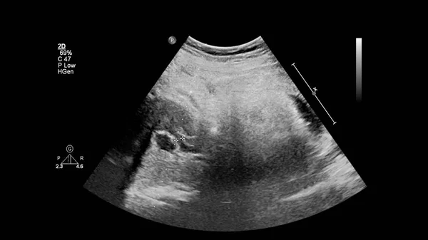 Ultraschalluntersuchung Des Fetalen Herzens Mit Hypoplastischem Linksherzsyndrom — Stockfoto