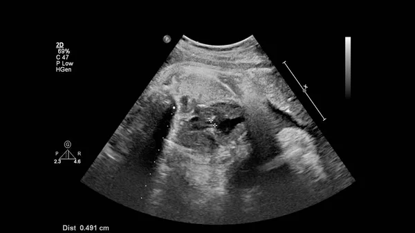 증후군으로 태아의 심장을 초음파 검사하는 — 스톡 사진