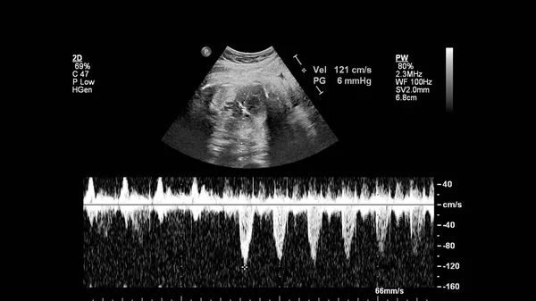 Exame Ultrassonográfico Coração Fetal Com Síndrome Coração Esquerdo Hipoplásico — Fotografia de Stock