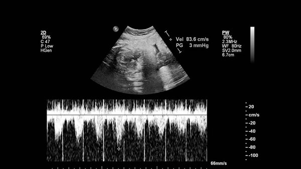 УЗИ сердца плода с синдромом гипоплазии левого сердца
.