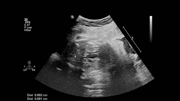 Echografie Van Het Foetale Hart Met Hypoplastisch Linkerhartsyndroom — Stockfoto