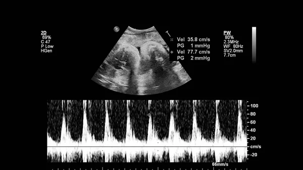 Fetüsün Sol Kalp Sendromlu Kalbinin Ultrason Muayenesi — Stok fotoğraf