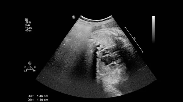 Fetüsün Sol Kalp Sendromlu Kalbinin Ultrason Muayenesi — Stok fotoğraf