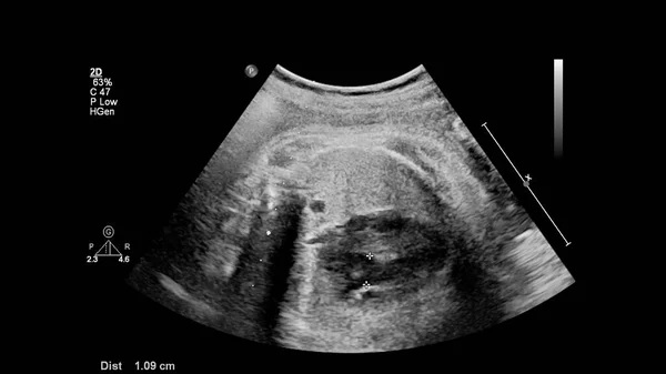 Ecografía Del Corazón Fetal Con Síndrome Hipoplásico Del Corazón Izquierdo —  Fotos de Stock