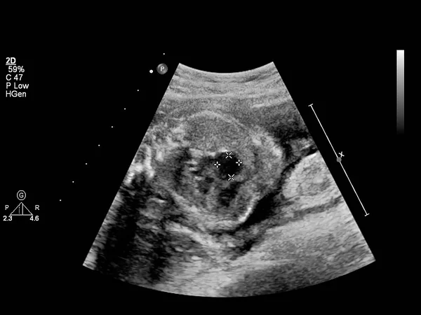 Ecrã Ultrassonográfico Com Ecocardiografia Fetal — Fotografia de Stock