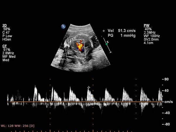 Fetal ekokardiyografi ile ultrasonografi ekranı
