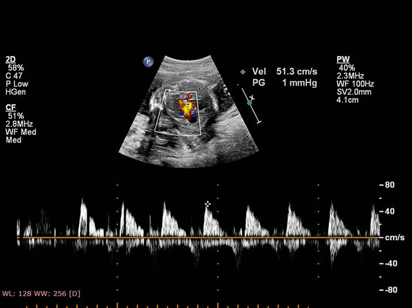 УЗИ с эхокардиографией плода
