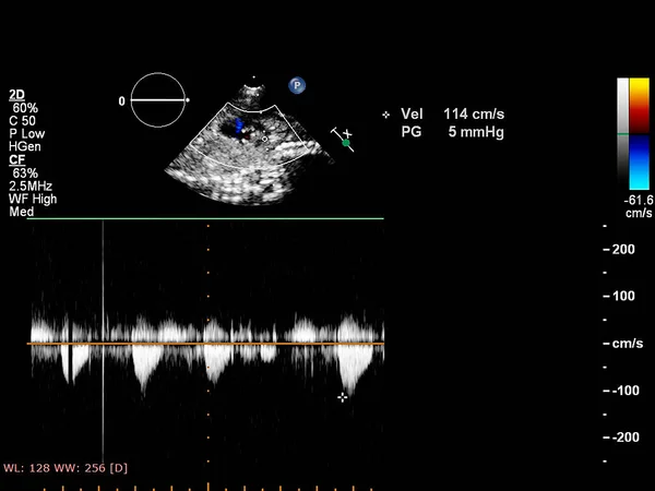 Fetal Ekokardiyografi Ile Ultrasonografi Ekranı — Stok fotoğraf