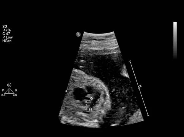 Ultrasound Screen Fetal Echocardiography — Stock Photo, Image